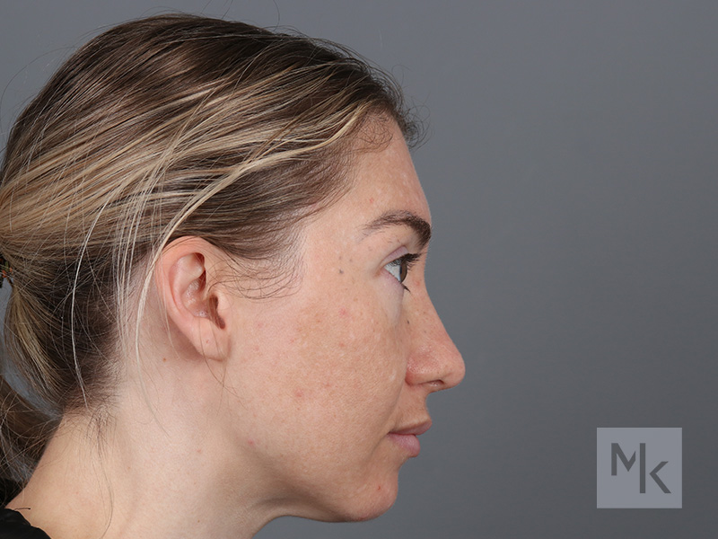 Rhinoplasty Before and After | Dr. Michael Kim