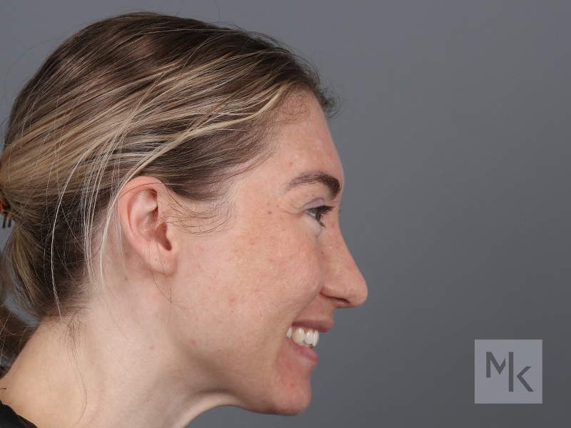 Rhinoplasty Before and After | Dr. Michael Kim