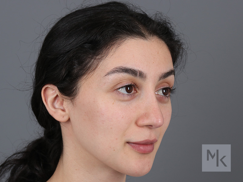 Rhinoplasty Before and After | Dr. Michael Kim