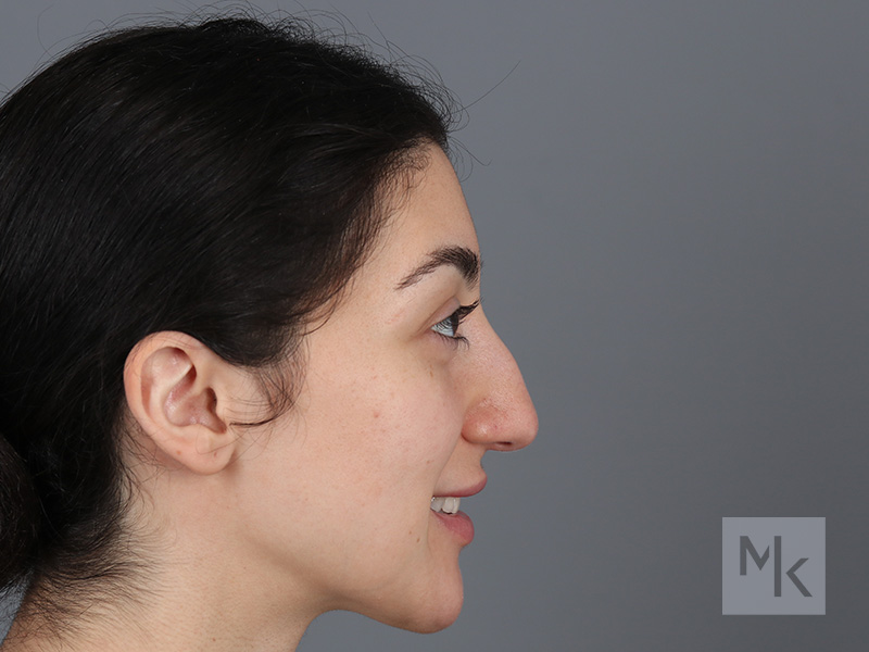 Rhinoplasty Before and After | Dr. Michael Kim