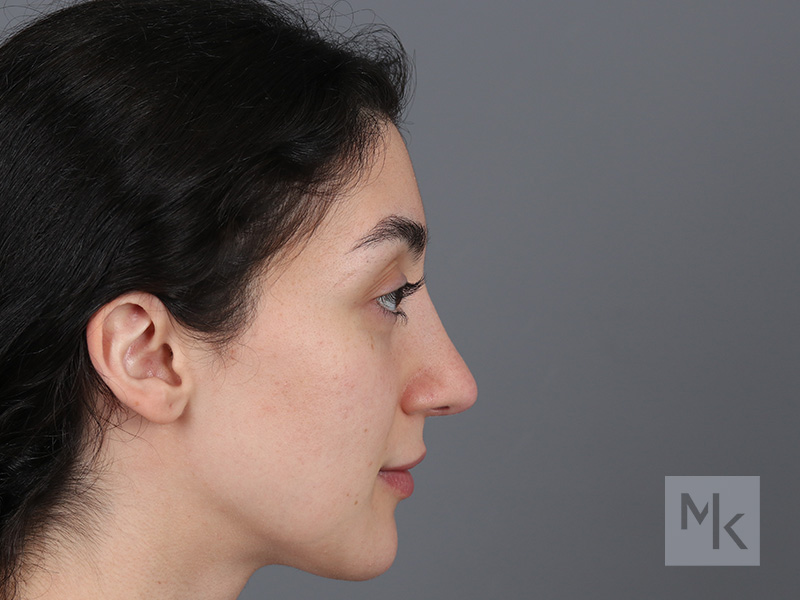 Rhinoplasty Before and After | Dr. Michael Kim