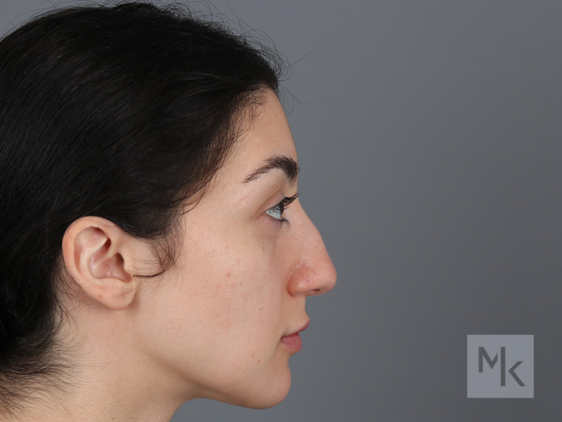 Rhinoplasty Before and After | Dr. Michael Kim