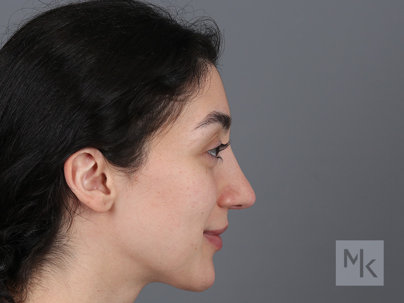 Rhinoplasty Before and After | Dr. Michael Kim