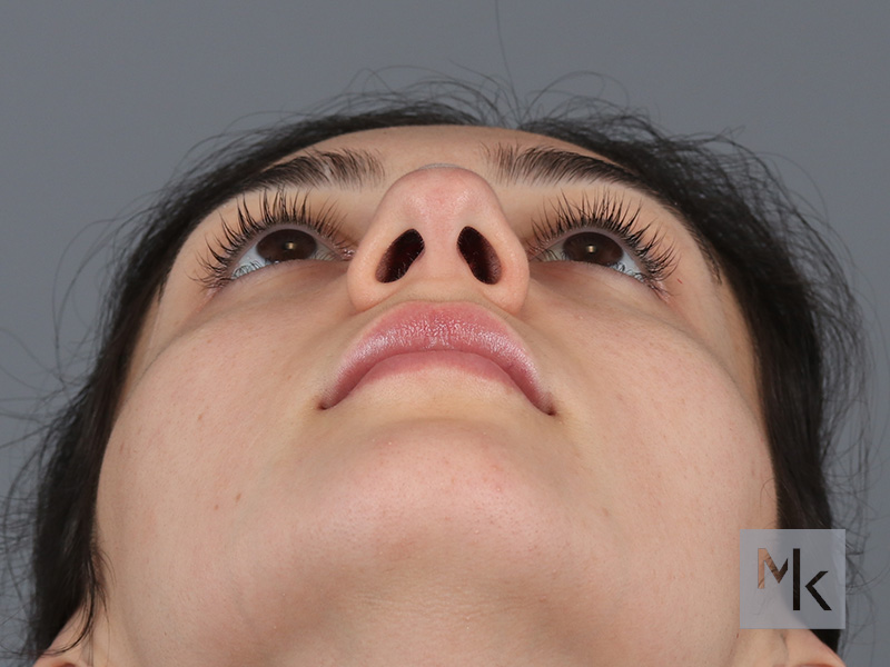 Rhinoplasty Before and After | Dr. Michael Kim