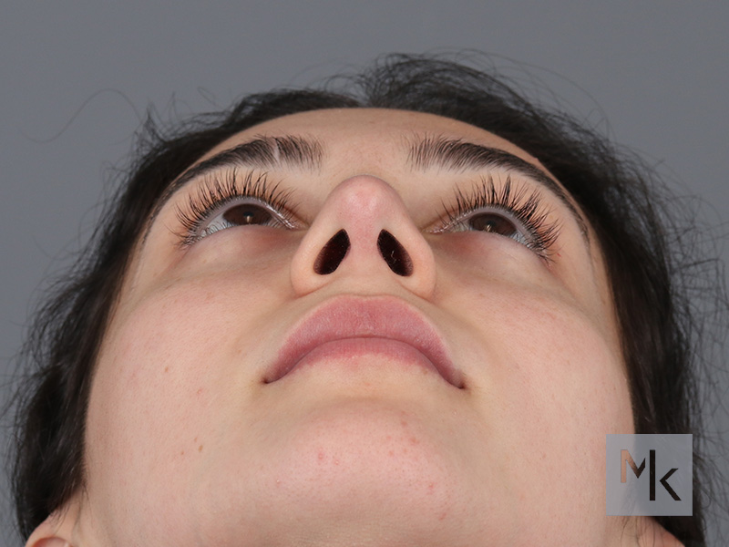 Rhinoplasty Before and After | Dr. Michael Kim