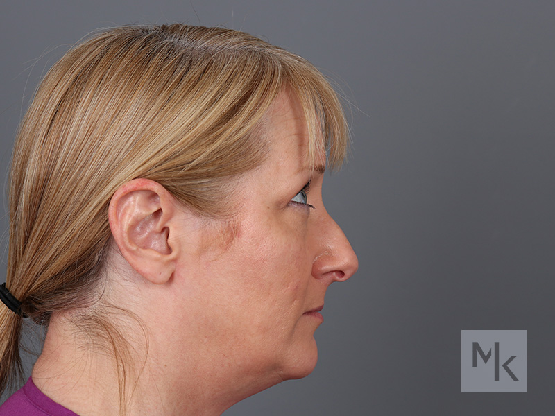 Rhinoplasty Before and After | Dr. Michael Kim