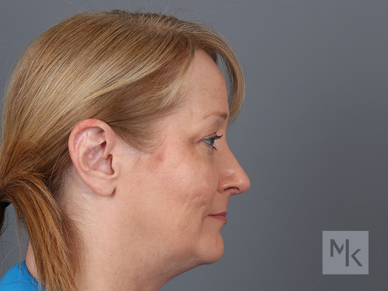 Rhinoplasty Before and After | Dr. Michael Kim