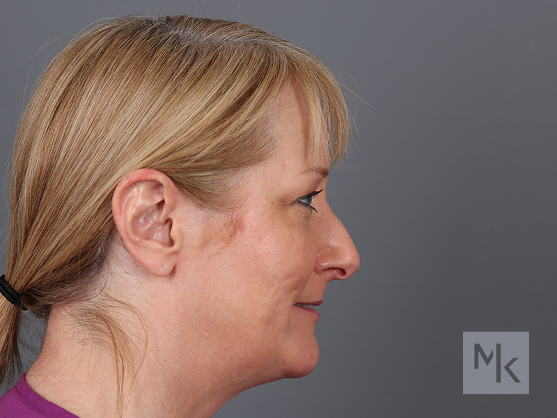 Rhinoplasty Before and After | Dr. Michael Kim