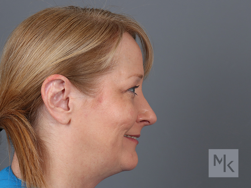 Rhinoplasty Before and After | Dr. Michael Kim