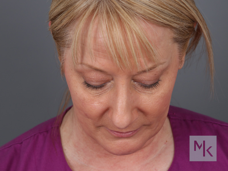 Rhinoplasty Before and After | Dr. Michael Kim