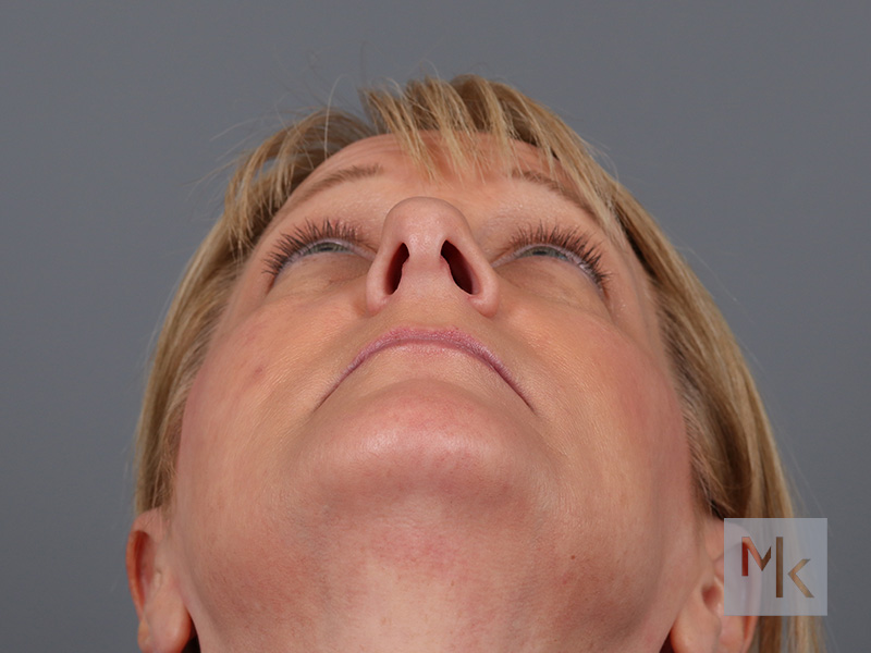 Rhinoplasty Before and After | Dr. Michael Kim