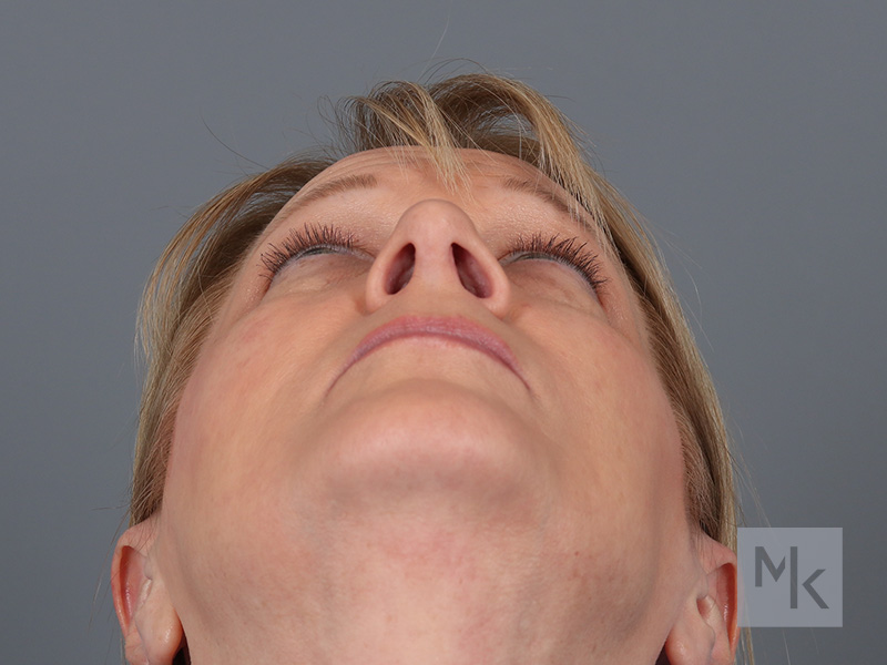 Rhinoplasty Before and After | Dr. Michael Kim