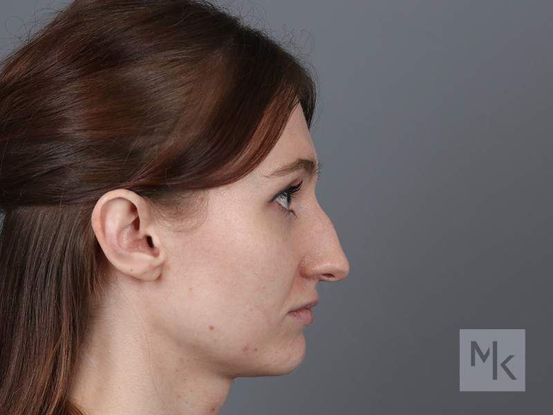 Rhinoplasty Before and After | Dr. Michael Kim