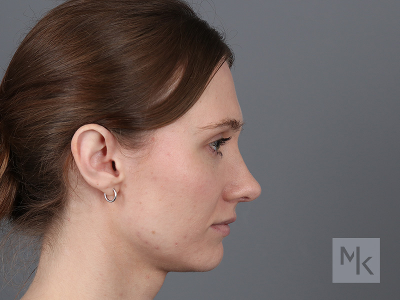 Rhinoplasty Before and After | Dr. Michael Kim