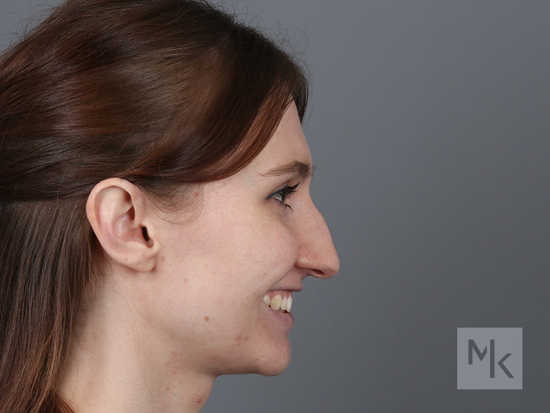 Rhinoplasty Before and After | Dr. Michael Kim