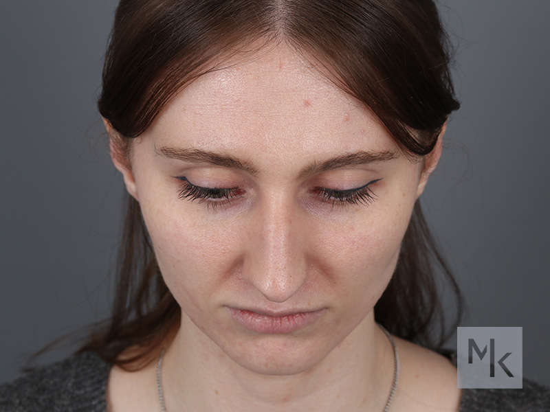 Rhinoplasty Before and After | Dr. Michael Kim