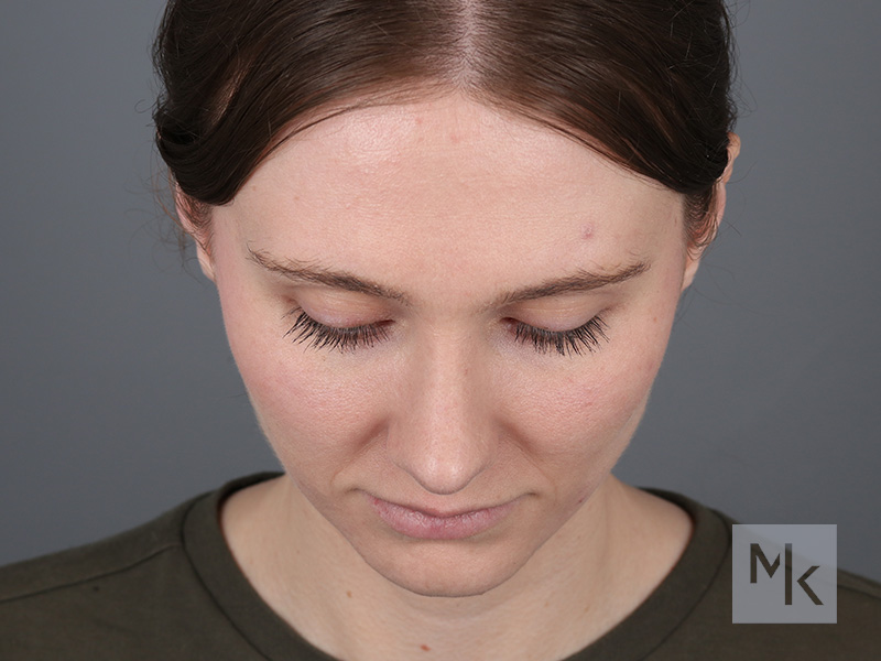 Rhinoplasty Before and After | Dr. Michael Kim