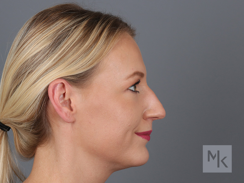 Rhinoplasty Before and After | Dr. Michael Kim