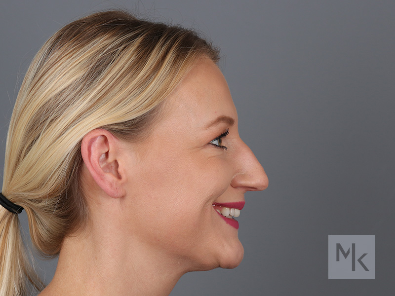 Rhinoplasty Before and After | Dr. Michael Kim