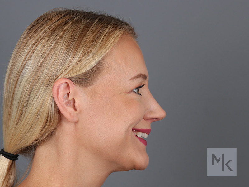 Rhinoplasty Before and After | Dr. Michael Kim