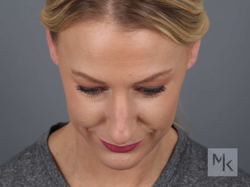 Rhinoplasty Before and After | Dr. Michael Kim