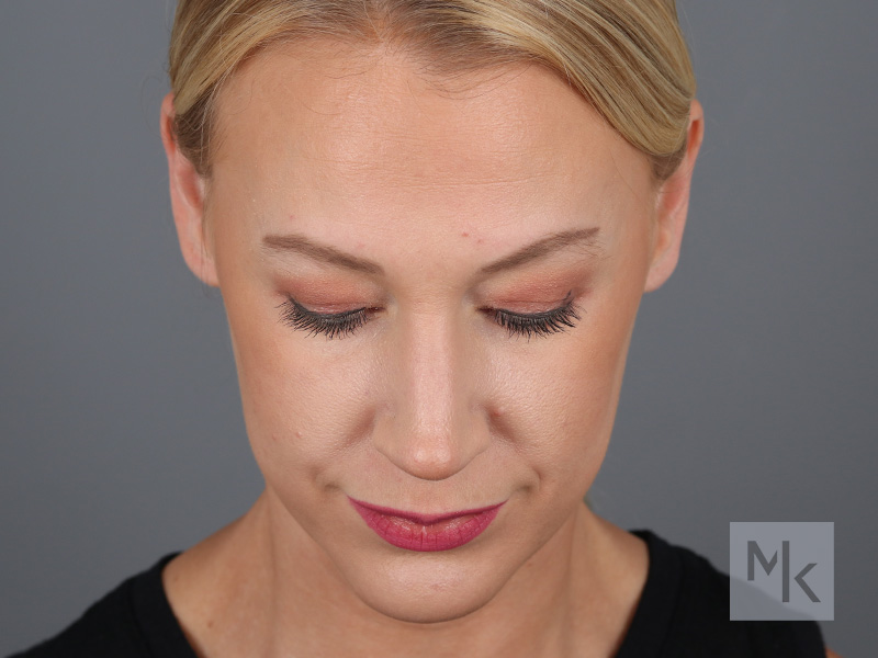 Rhinoplasty Before and After | Dr. Michael Kim