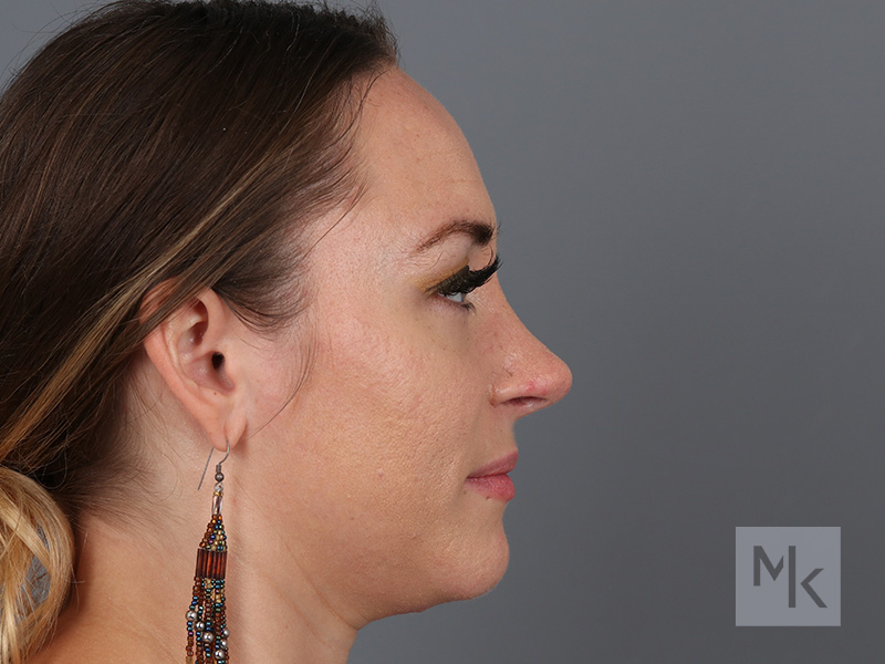 Rhinoplasty Before and After | Dr. Michael Kim