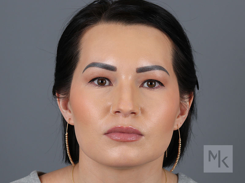 Rhinoplasty Before and After | Dr. Michael Kim