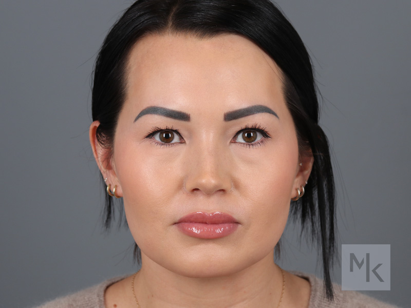 Rhinoplasty Before and After | Dr. Michael Kim