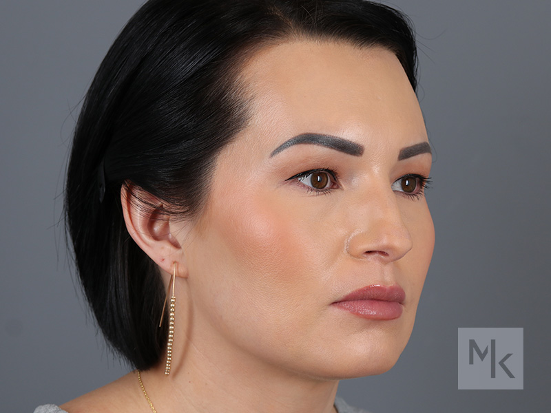 Rhinoplasty Before and After | Dr. Michael Kim