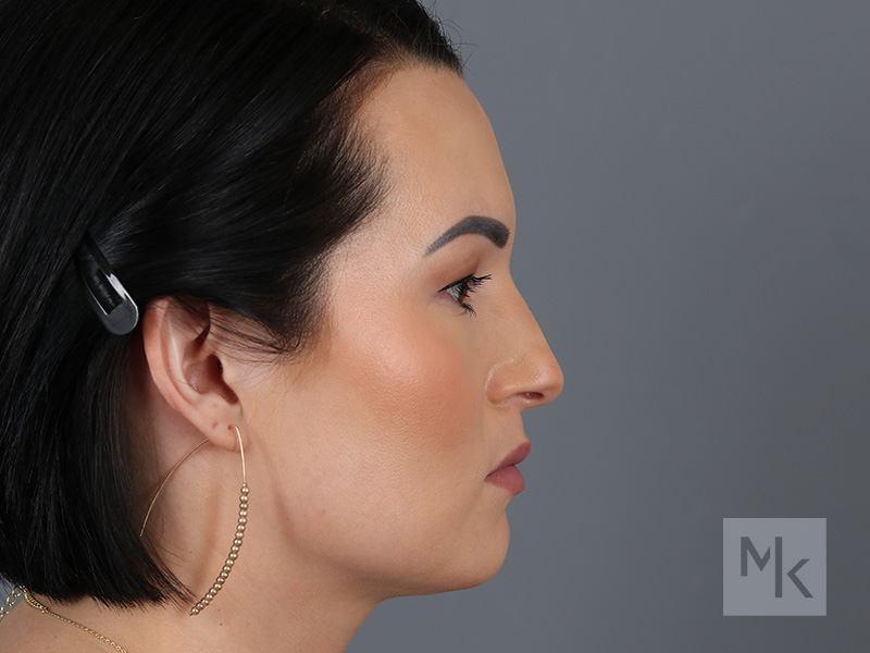 Rhinoplasty Before and After | Dr. Michael Kim