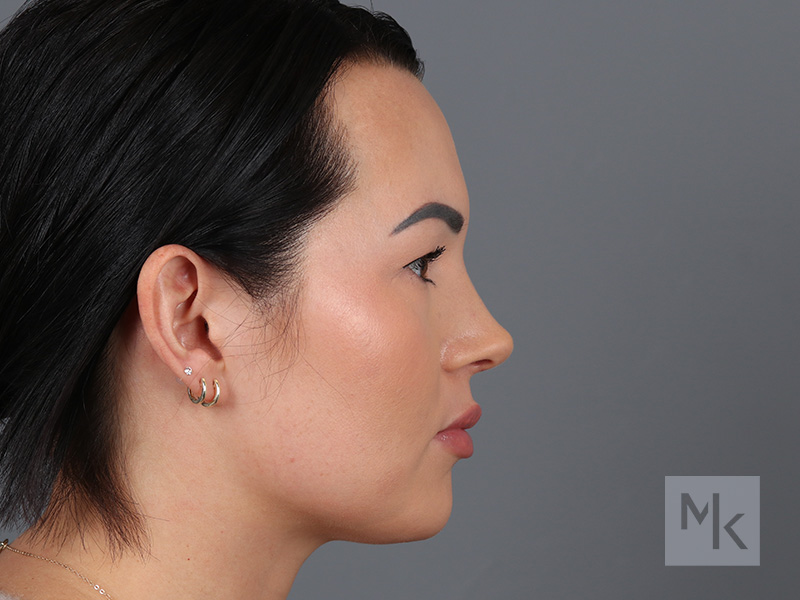 Rhinoplasty Before and After | Dr. Michael Kim