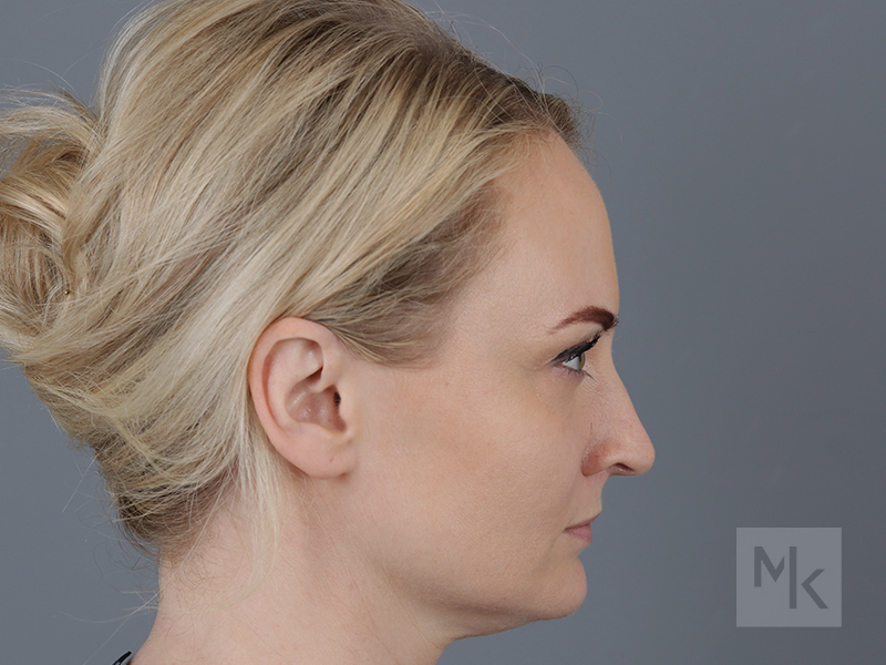 Rhinoplasty Before and After | Dr. Michael Kim