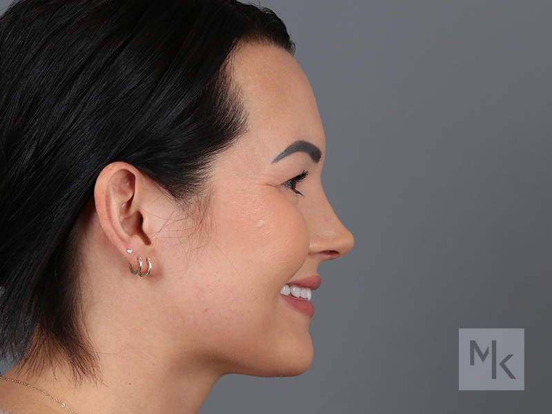 Rhinoplasty Before and After | Dr. Michael Kim