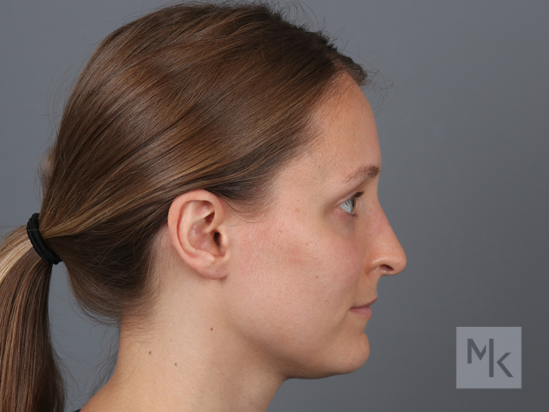 Rhinoplasty Before and After | Dr. Michael Kim