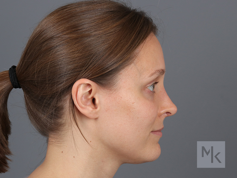 Rhinoplasty Before and After | Dr. Michael Kim