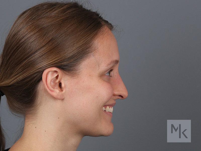 Rhinoplasty Before and After | Dr. Michael Kim