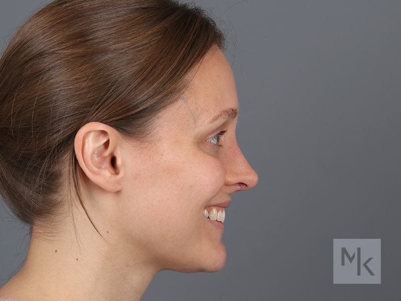 Rhinoplasty Before and After | Dr. Michael Kim