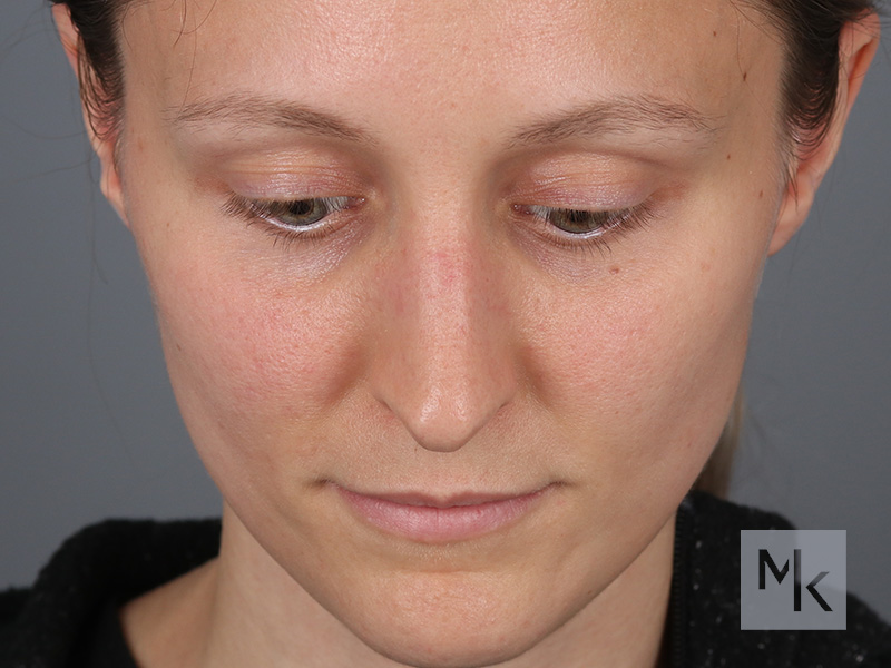 Rhinoplasty Before and After | Dr. Michael Kim