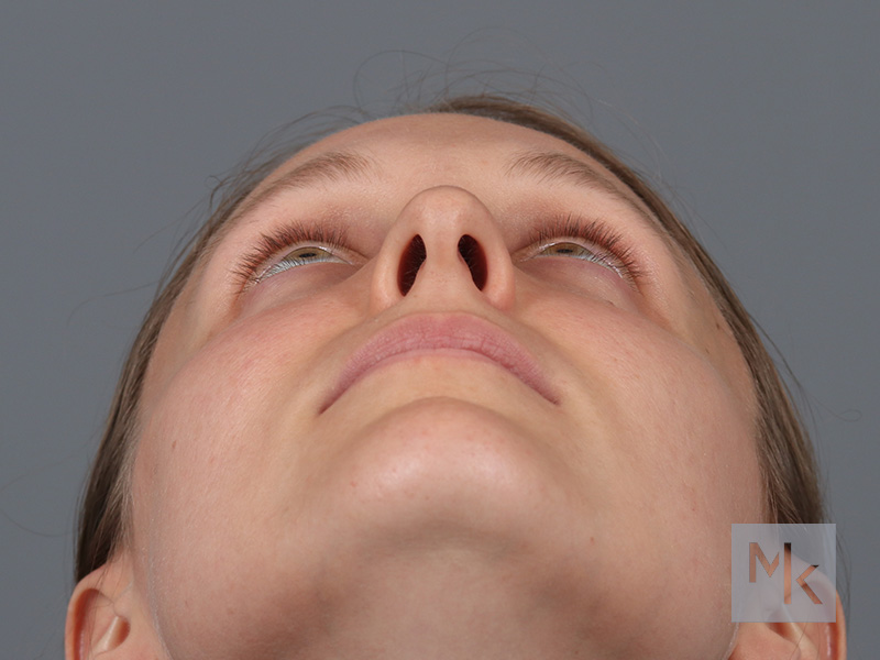 Rhinoplasty Before and After | Dr. Michael Kim