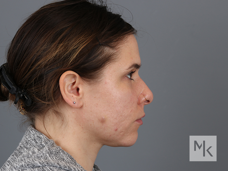 Rhinoplasty Before and After | Dr. Michael Kim