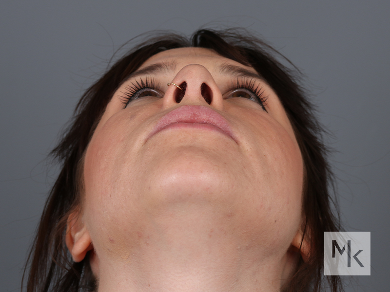 Rhinoplasty Before and After | Dr. Michael Kim