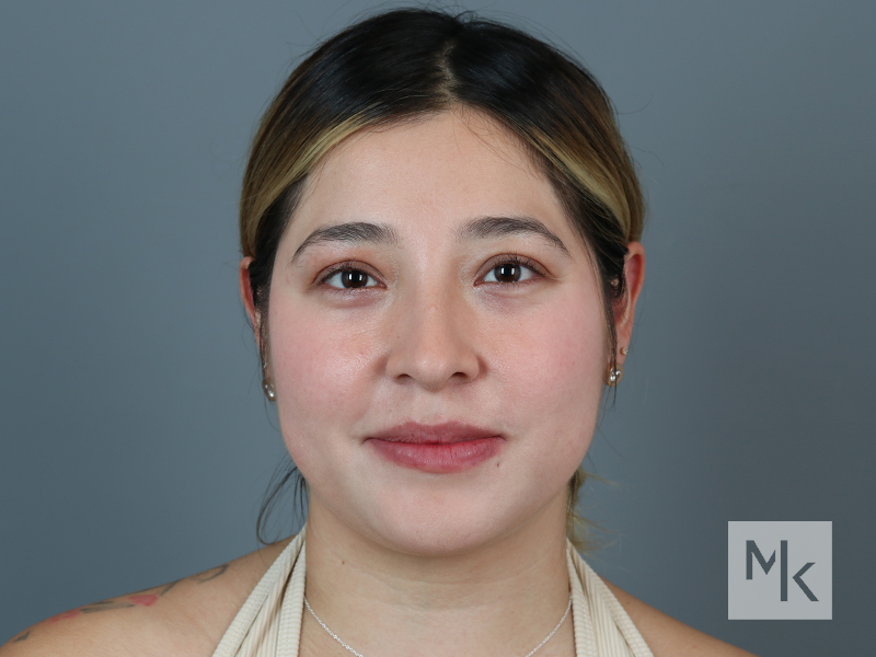 Rhinoplasty Before and After | Dr. Michael Kim