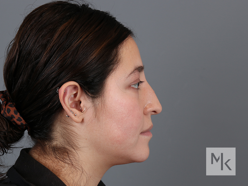 Rhinoplasty Before and After | Dr. Michael Kim