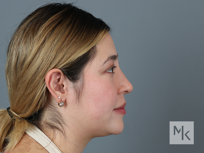 Rhinoplasty Before and After | Dr. Michael Kim