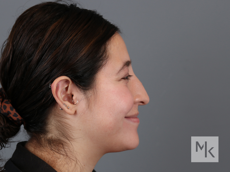 Rhinoplasty Before and After | Dr. Michael Kim