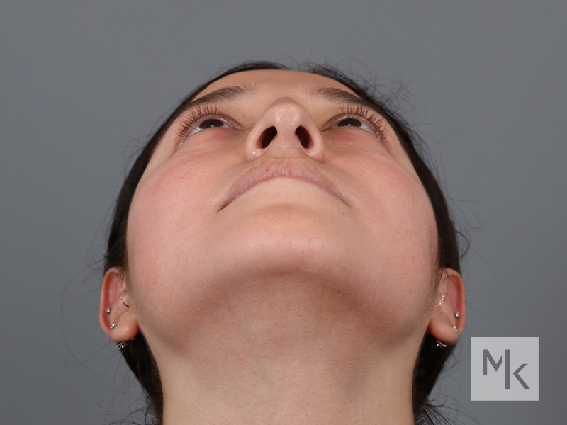 Rhinoplasty Before and After | Dr. Michael Kim