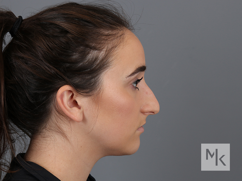 Rhinoplasty Before and After | Dr. Michael Kim