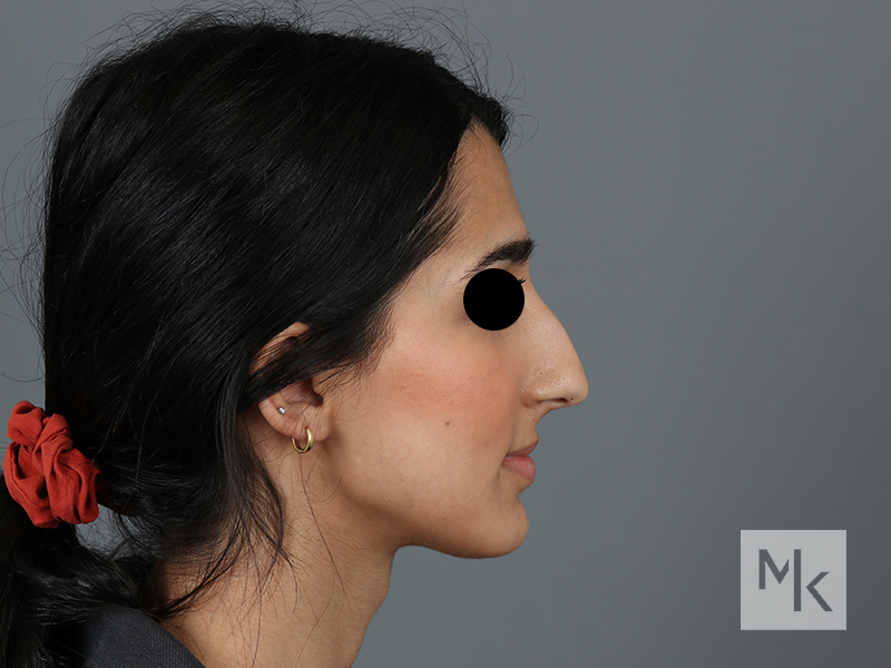 Rhinoplasty Before and After | Dr. Michael Kim