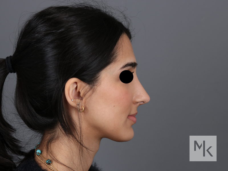 Rhinoplasty Before and After | Dr. Michael Kim